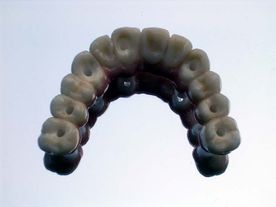 Centro de Prótesis Dentales El Pilar implante dental